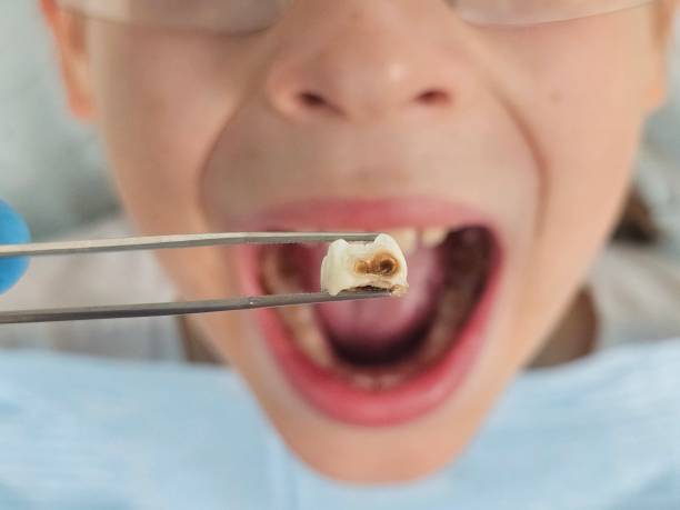 Best Emergency Wisdom Teeth Removal in Ashwaubenon, WI